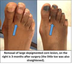 To revisit this article, visit my profile, thenview saved stories. Cosmetic Foot Surgery Home Facebook