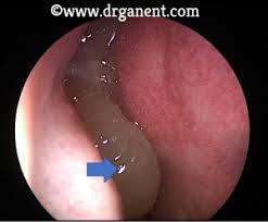 If the polyps are small and do not obstruct the nasal cavity, you may not have many symptoms. What Are Nasal Polyps Warning Graphic Medical Images And Video Dr Gan Eng Cern