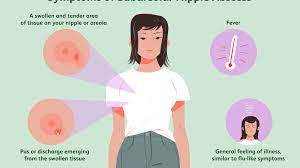 Subareolar Nipple Abscess Symptoms Causes Diagnosis And Treatment