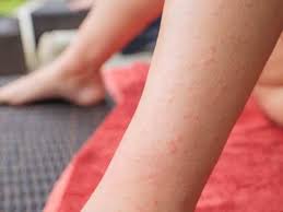 Check spelling or type a new query. Coronavirus Symptoms Skin Rash Could A Prominent Symptom Suggests A Study The Times Of India