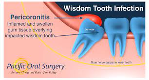 Wisdom Tooth Infection Pericoronitis In Ventura Ca Pacific Oral Surgery