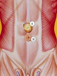 Take a quick quiz to receive your personalized keto diet plan. Types Of Hernia Everyday Health