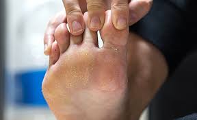 Image result for Pitting nails feet