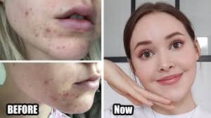 Also, the primary stress hormone, cortisol, can also trigger testosterone production. How To Really Get Rid Of Acne Texture Acne Scars Skin Damage Adult Hormonal Acne Youtube