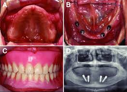 Gingivalis in 15 of 16 and 8 of 16 previously positive patients using. A B Intraoral View After Extraction Of Tooth And Implant Surgery Download Scientific Diagram