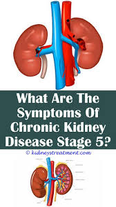 Acute Dialysis Polycystic Kidney Disease Kidney Disease Stages Kidney Disease