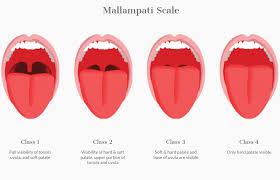 In anesthesia, the mallampati score, also mallampati classification, is used to predict the ease of intubation.1 it is determined by looking at the anatomy of the oral a high mallampati score (class 3 or 4) is associated with more difficult intubation as well as a higher incidence of sleep apnea.2. Sleep Apnea Dr Edward C Yates