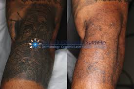 So, add another $500 or so and that adds up to $3,750. Tattoo Removal Washington Dc Center For Laser Surgery