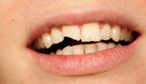 Golpe En Los Dientes Que Hacer Ante Un Traumatismo Dental