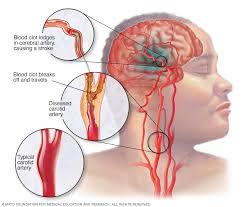 Image result for carotid artery