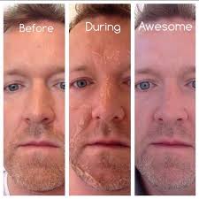 Corrective Skincare On Instagram Think The Vipeel Is Just For The Ladies Nope Skin Is Skin And Anyone Chemical Peel Natural Skin Tightening Facial Peel