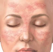 Maybe you would like to learn more about one of these? Was Ist Lupus Erythematodes Schmetterlingsflechte