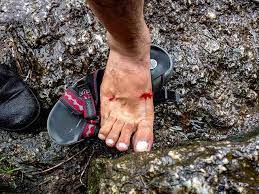 How To (Safely) Remove A Leech - Mom Goes Camping