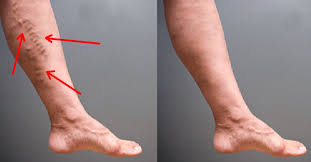 простуда на губе как быстро вылечить в домашних условиях Vsego 1 Lozhka Etoj Smesi Izbavit Ot Varikoza I Sosudistoj Setki Na Nogah Fitness Training Beauty Hair Beauty