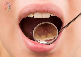 Crest.com has been visited by 10k+ users in the past month Simple Ways To Get Tartar At Home