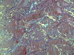 Congo red dye forms nonpolar hydrogen bonds with amyloid and red to apple green birefringence occurs when viewed by polarized light due to alignment of dye molecules on the lineraly arranged amyloid fibrils. Case Of The Week 247