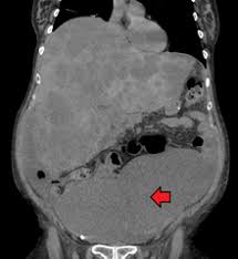 One of the most common symptoms of cat cancer are lumps and bumps. unusual lumps that change size could be a sign of cancer. Colorectal Cancer Wikipedia