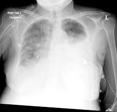 Pleural effusion (transudate or exudate) is an accumulation of fluid in the chest or on the lung. Differential Diagnosis Of Pleural Effusion