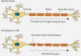 Pathogenesis, diagnosis, treatment and prognosis. Le Syndrome De Guillain Barre Est Une Maladie Qui Se Qcm N 1368