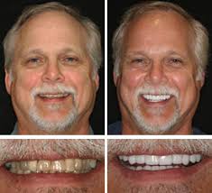 We accept government dental insurances. Veneers Austins Best The Cosmetic Dentists Of Austin