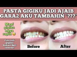 Pin Di Cr Mmutihkn Gigi