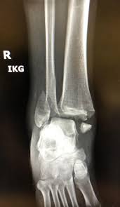 Image result for Ankle XRay