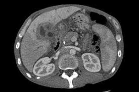 And others will continue to live comfortably for months on end. Liver Cancer Wikipedia
