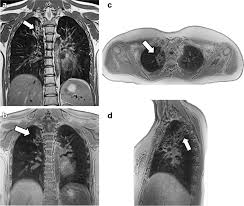 Image result for Bronchiectasis