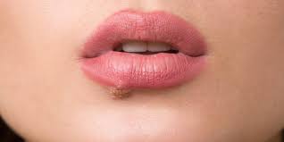 Wann und wie lange ist herpes bei pferden ansteckend? Hausmittel Gegen Herpes Heilpraxis