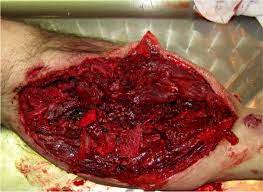 Gunshot wounds result from the discharge of projectiles by firearms. Pathology Outlines Gunshot Wounds