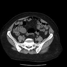 Mucocele Of Appendix Radiology Case Radiopaedia Org They represent a developmental remnant. mucocele of appendix radiology case