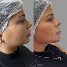 Eu amo um perfil harmonizado, ressaltando a beleza natural e de forma  gradual🌟 #harmonizaçãofacial