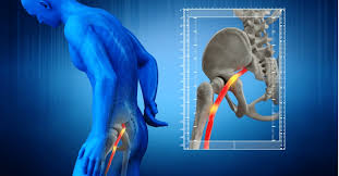 Pain that worsens with movement; The Lower Back Leg Pain And Sciatica Pro Rehab Chiropractic Chiropractors