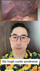 Fitz Hugh Curtis Syndrome: สาเหตุและการรักษา