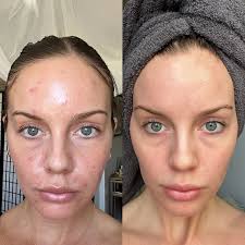 Gin Amber's 0.5mm Dermaroller