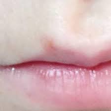 Eigentlich sind die lippen kaum mit talgdrüsen ausgestattet, der gewöhnlichen „brutstätte für pickel, mitesser und akne. Pickel Auf Der Lippe Was Tun Pubertat