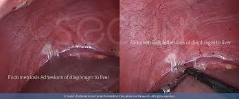 Ultrasound, mri and ct scan. Thoracic Endometriosis Dr Seckin