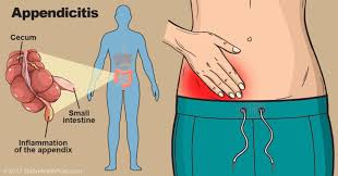 Image result for appendix
