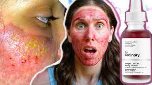 Overexfoliation 911 - How To Recover From The Ordinary's Aha Bha Peel /  Minor Chemical Burns - Youtube