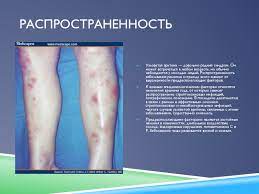 Она может быть проявлением многих состояний и заболеваний. Uzlovataya Eritema Prezentaciya Doklad