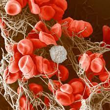 It was first identified in december 2019 in wuhan,. Blood Clots Leave Clinicians With Clues About Covid 19 But No Proven Treatments
