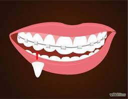 How To Make Vampire Fangs If You Have Braces 12 Steps Vampire Fangs Vampire Fangs Diy Vampire Halloween Costume