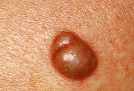 Ingrown hairs often heal without any treatment. Skin Problems Skin Conditions Below The Waist