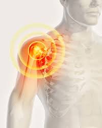Schleimbeutelentzundung Der Schulter Subakromiale Bursitis Www Gelenk Doktor De