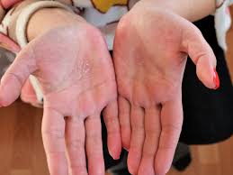 Image result for dermatitis contacta