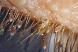 Eye Mites Burrow Head First Into Your Lash Follicles Eye Mites Eyelash Mites Lice Remedies
