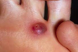 Blood blister on foot under skin. Blisters Nhs