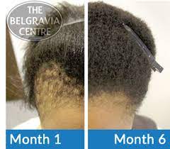 Artificial hair integrations, more commonly known as hair extensions or hair weaves, add length and fullness to human hair. Women With Afro Hair Ditch Damaging Weaves And Chemical Treatments