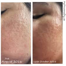 With 14% glycolic acid, 0.5% retinol and papaya enzyme it helps to boost collagen, stimulate skin renewal and reduce surface imperfections. Indented Acne Scars Skin Progress Pictures Update 1
