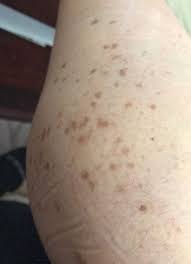 Image result for liver spots on legs
